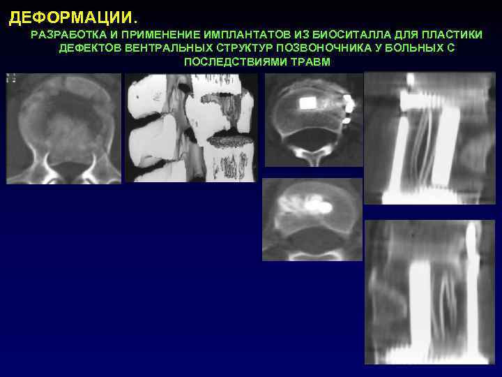 ДЕФОРМАЦИИ. РАЗРАБОТКА И ПРИМЕНЕНИЕ ИМПЛАНТАТОВ ИЗ БИОСИТАЛЛА ДЛЯ ПЛАСТИКИ ДЕФЕКТОВ ВЕНТРАЛЬНЫХ СТРУКТУР ПОЗВОНОЧНИКА У