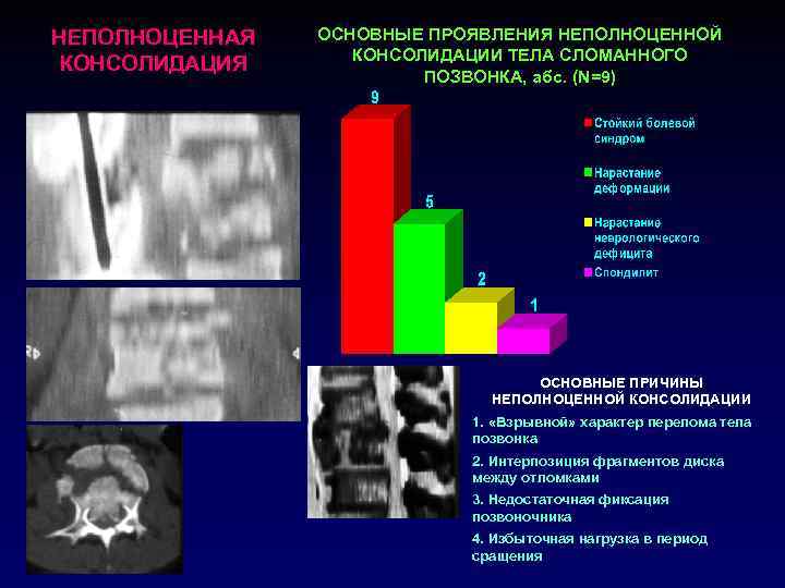 НЕПОЛНОЦЕННАЯ КОНСОЛИДАЦИЯ ОСНОВНЫЕ ПРОЯВЛЕНИЯ НЕПОЛНОЦЕННОЙ КОНСОЛИДАЦИИ ТЕЛА СЛОМАННОГО ПОЗВОНКА, абс. (N=9) ОСНОВНЫЕ ПРИЧИНЫ НЕПОЛНОЦЕННОЙ