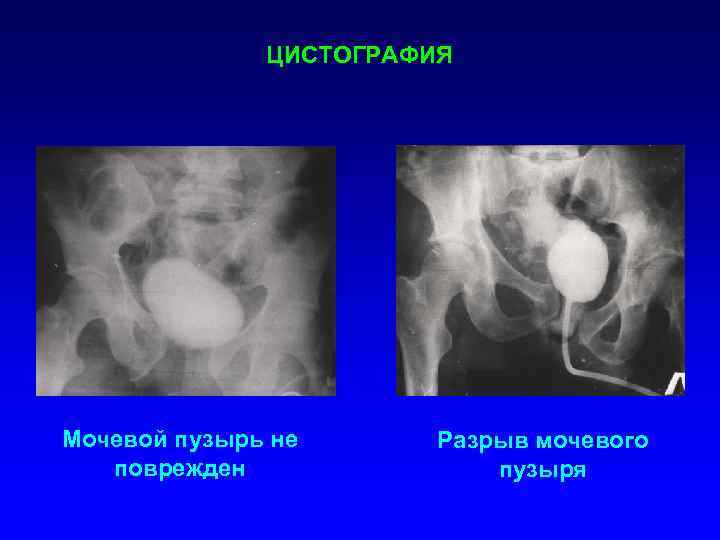 Пороки развития мочевого пузыря и уретры презентация