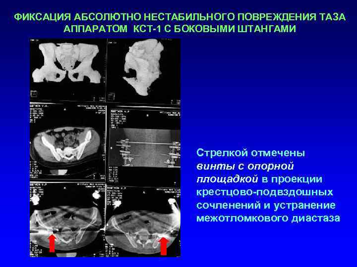 Травмы таза травматология презентация