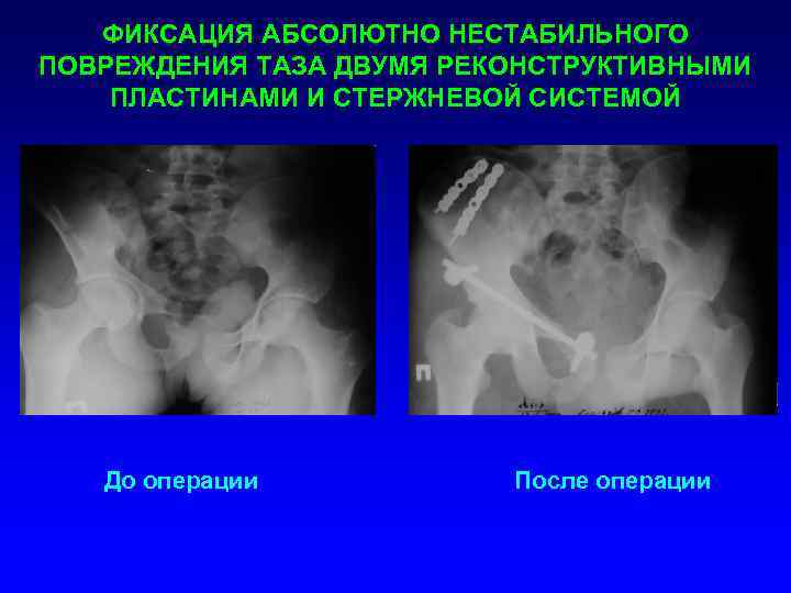 Повреждения таза травматология презентация