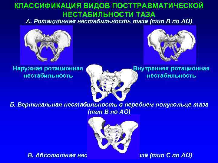 Травма таза. Ротационно нестабильные переломы таза. Нестабильный перелом таза. Классификация костей таза. Нестабильность тазового кольца.