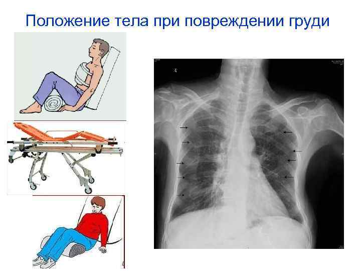Положение тела при повреждении груди 