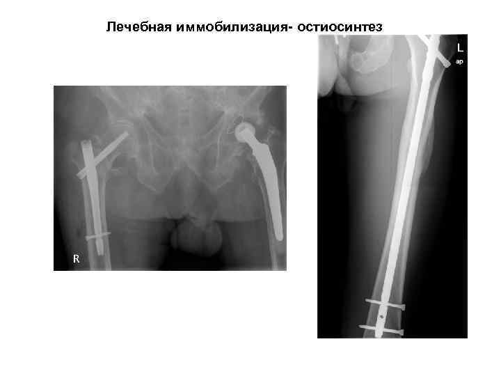 Лечебная иммобилизация- остиосинтез 