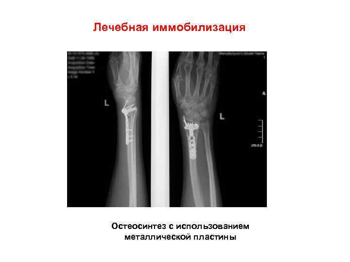 Лечебная иммобилизация Остеосинтез с использованием металлической пластины 