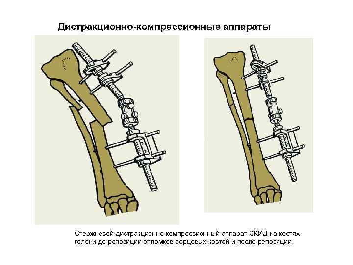 Дистракционно-компрессионные аппараты Стержневой дистракционно-компрессионный аппарат СКИД на костях голени до репозиции отломков берцовых костей