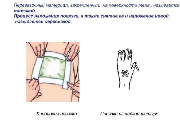 Перевязочный материал, закрепленный на поверхности тела , называется повязкой. Процесс наложения повязки, а также