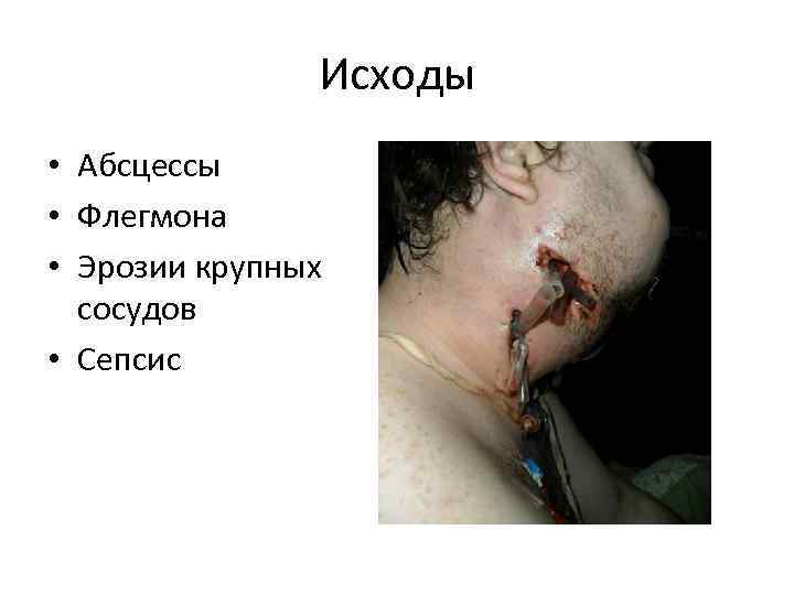 Исходы • Абсцессы • Флегмона • Эрозии крупных сосудов • Сепсис 