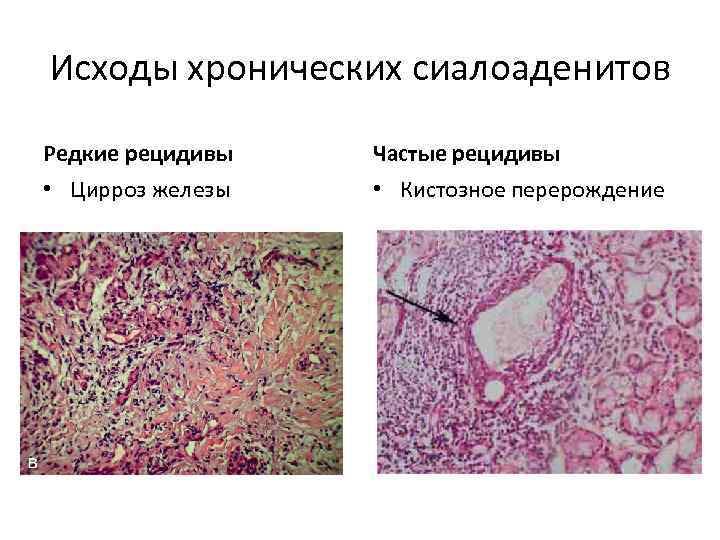Исходы хронических сиалоаденитов Редкие рецидивы Частые рецидивы • Цирроз железы • Кистозное перерождение 