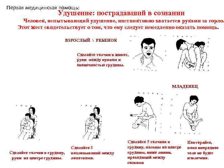 Первая медицинская помощь: Удушение: пострадавший в сознании Человек, испытывающий удушение, инстинктивно хватается руками за