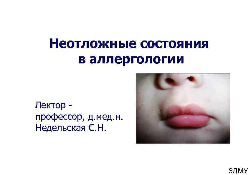 Неотложные состояния в аллергологии Лектор профессор, д. мед. н. Недельская С. Н. ЗДМУ 