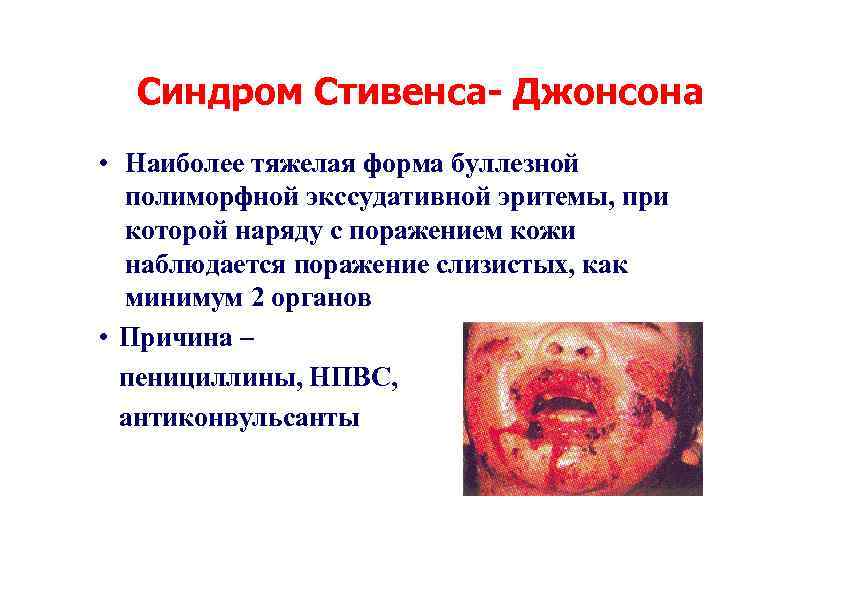 Синдром Стивенса- Джонсона • Наиболее тяжелая форма буллезной полиморфной экссудативной эритемы, при которой наряду