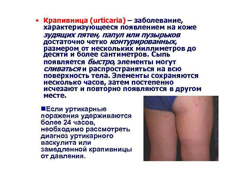  • Крапивница (urticaria) – заболевание, характеризующееся появлением на коже зудящих пятен, папул или