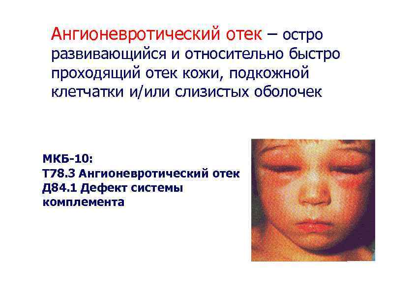 Ангионевротический отек – остро развивающийся и относительно быстро проходящий отек кожи, подкожной клетчатки и/или