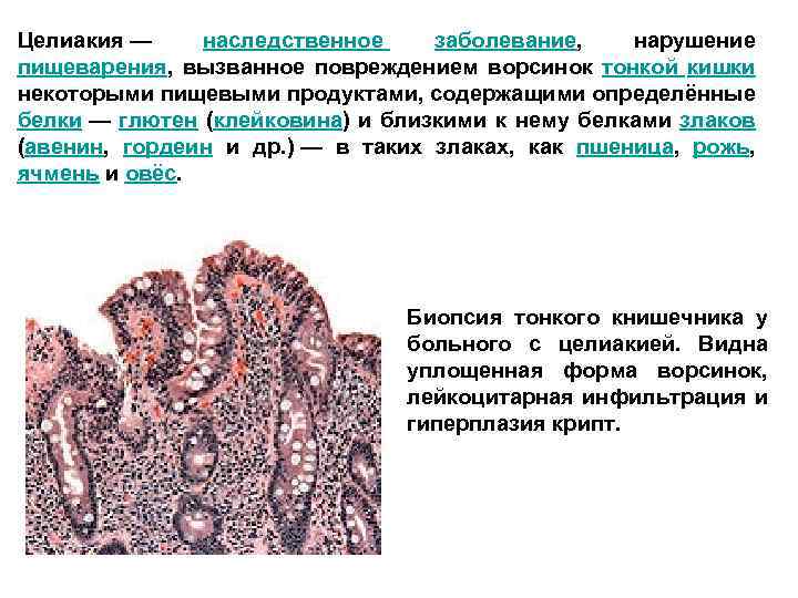 Целиакия — наследственное заболевание, нарушение пищеварения, вызванное повреждением ворсинок тонкой кишки некоторыми пищевыми продуктами,