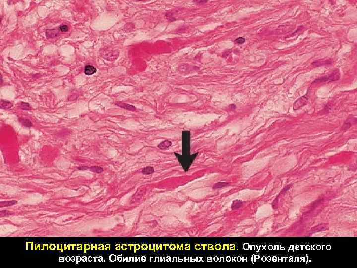 Пилоцитарная астроцитома ствола. Опухоль детского возраста. Обилие глиальных волокон (Розенталя). 