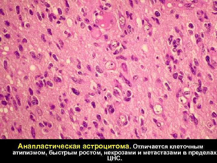 Анапластическая астроцитома. Отличается клеточным атипизмом, быстрым ростом, некрозами и метастазами в пределах ЦНС. 