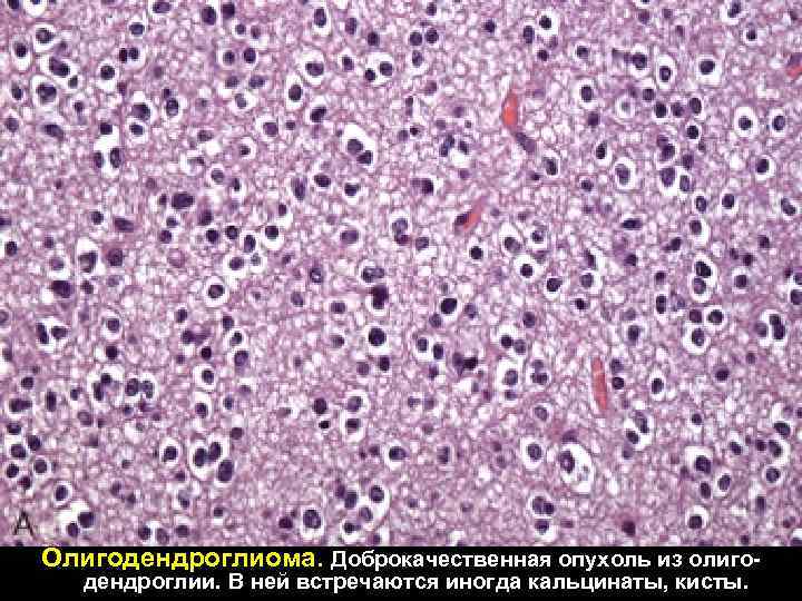 Олигодендроглиома. Доброкачественная опухоль из олигодендроглии. В ней встречаются иногда кальцинаты, кисты. 