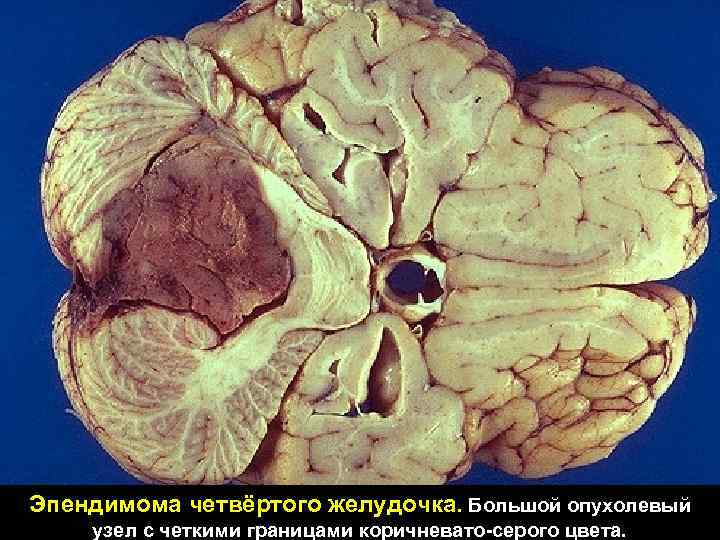 Эпендимома четвёртого желудочка. Большой опухолевый узел с четкими границами коричневато-серого цвета. 