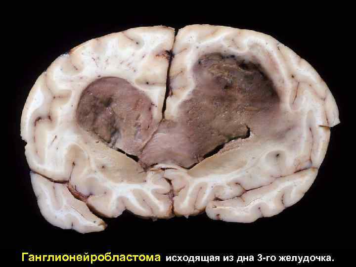 Ганглионейробластома исходящая из дна 3 -го желудочка. 