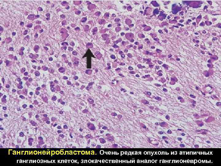 Ганглионейробластома. Очень редкая опухоль из атипичных ганглиозных клеток, злокачественный аналог ганглионевромы. 