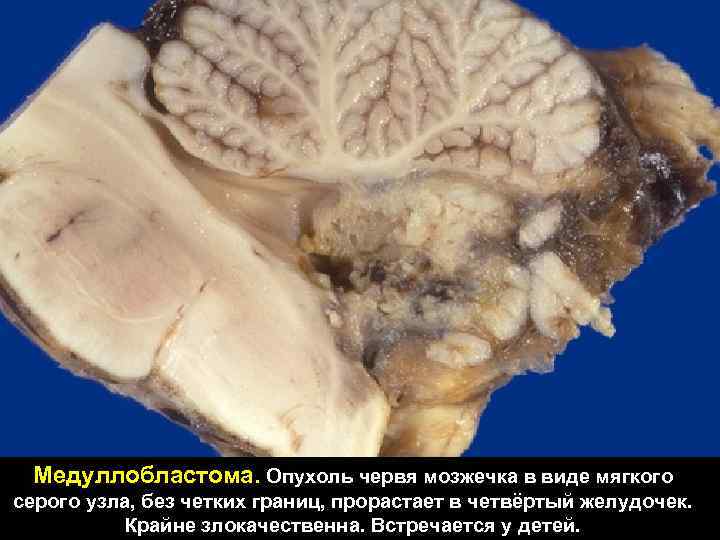 Медуллобластома. Опухоль червя мозжечка в виде мягкого серого узла, без четких границ, прорастает в