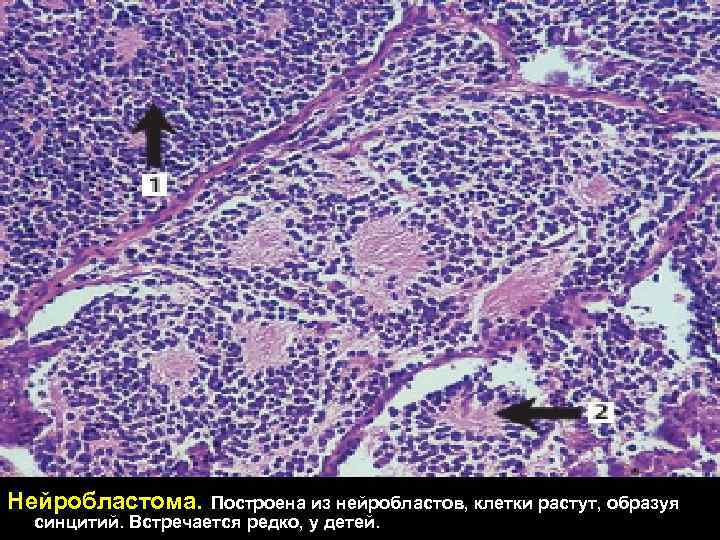 Нейробластома. Построена из нейробластов, клетки растут, образуя синцитий. Встречается редко, у детей. 