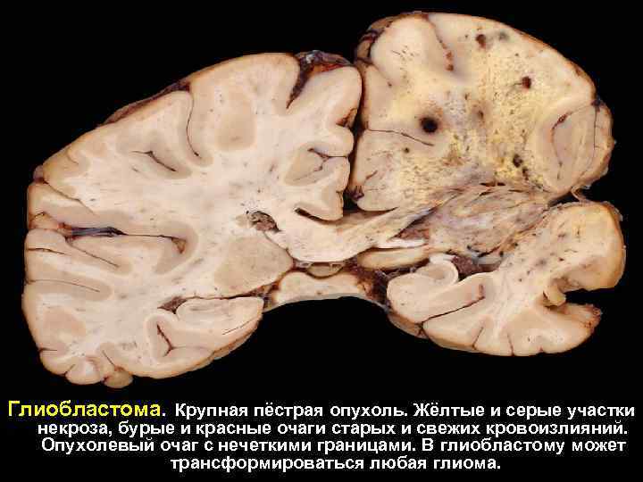 Глиобластома. Крупная пёстрая опухоль. Жёлтые и серые участки некроза, бурые и красные очаги старых