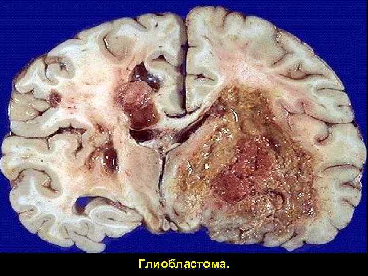 Глиобластома. 