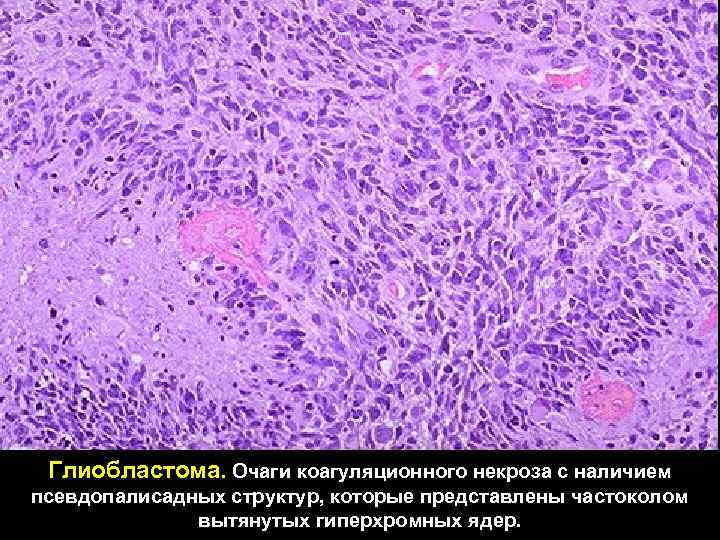 Глиобластома. Очаги коагуляционного некроза с наличием псевдопалисадных структур, которые представлены частоколом вытянутых гиперхромных ядер.