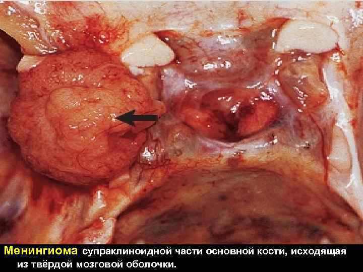 Менингиома супраклиноидной части основной кости, исходящая из твёрдой мозговой оболочки. 