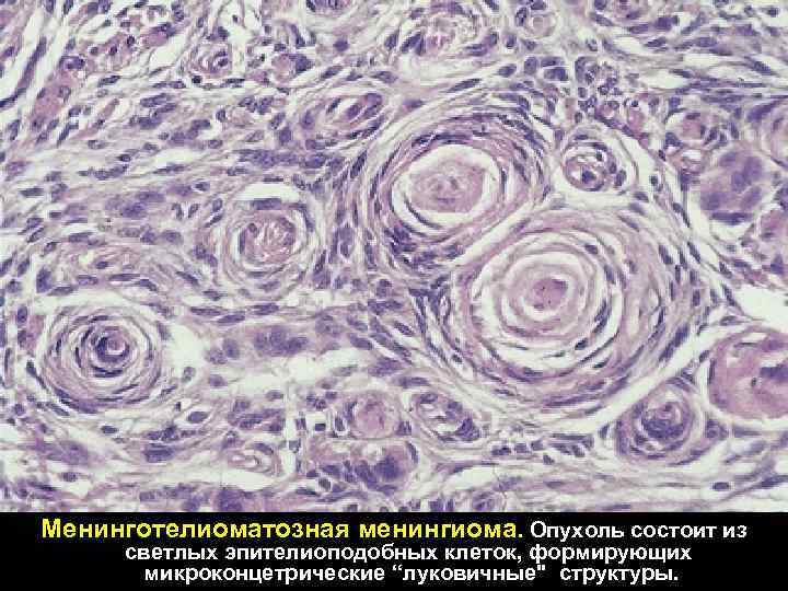 Менинготелиоматозная менингиома. Опухоль состоит из светлых эпителиоподобных клеток, формирующих микроконцетрические “луковичные