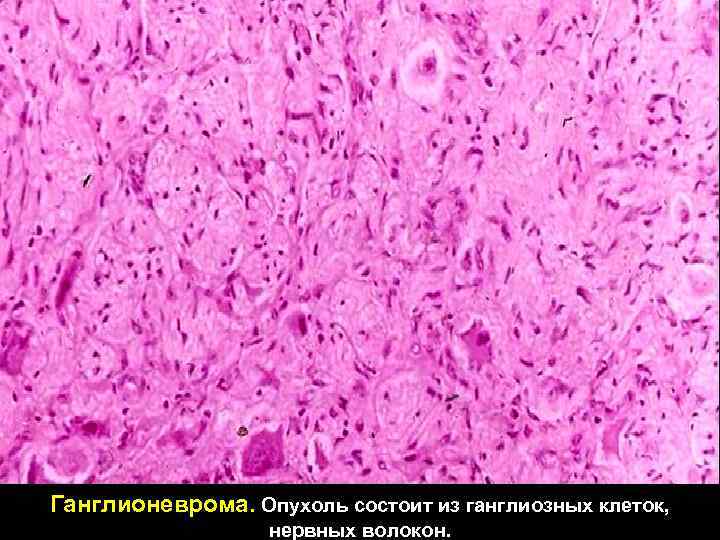 Ганглионеврома. Опухоль состоит из ганглиозных клеток, нервных волокон. 