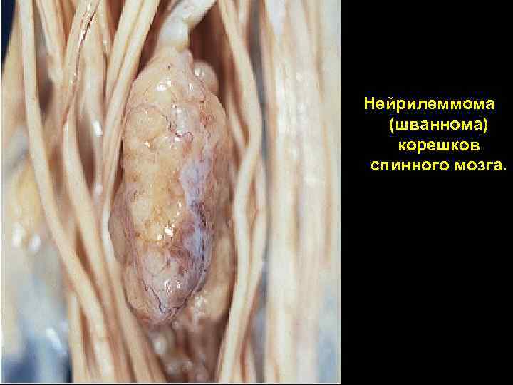 Нейрилеммома (шваннома) корешков спинного мозга. 