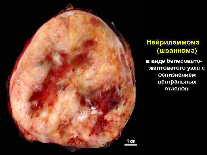 Нейрилеммома (шваннома) в виде белесоватожелтоватого узла с ослизнением центральных отделов. 