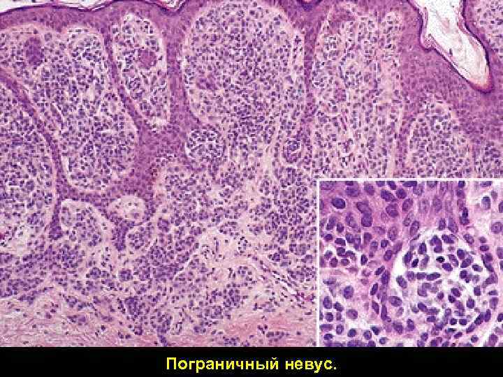 Пограничный невус. 