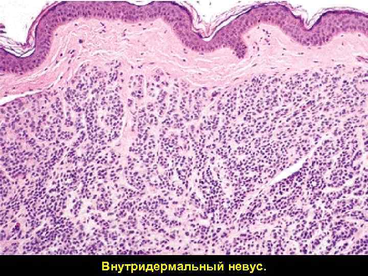 Внутридермальный невус. 