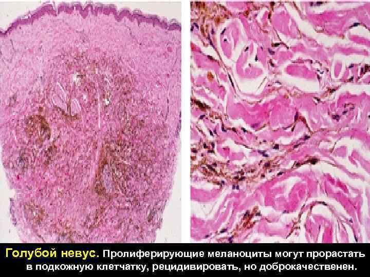 Голубой невус. Пролиферирующие меланоциты могут прорастать в подкожную клетчатку, рецидивировать, но доброкачественен. 