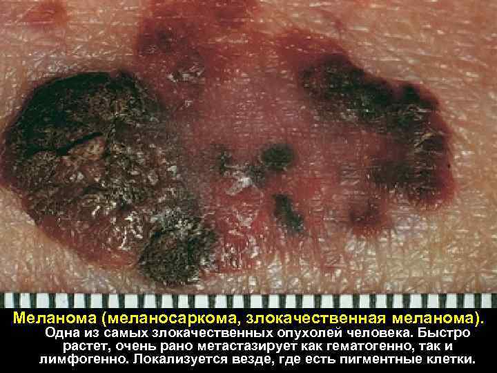 Меланома (меланосаркома, злокачественная меланома). Одна из самых злокачественных опухолей человека. Быстро растет, очень рано