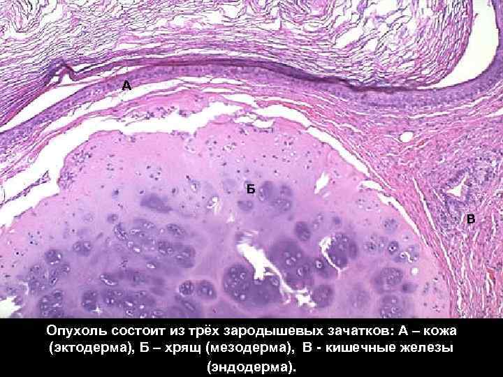 А Б В Опухоль состоит из трёх зародышевых зачатков: А – кожа (эктодерма), Б