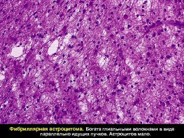 Фибриллярная астроцитома. Богата глиальными волокнами в виде параллельно идущих пучков. Астроцитов мало. 