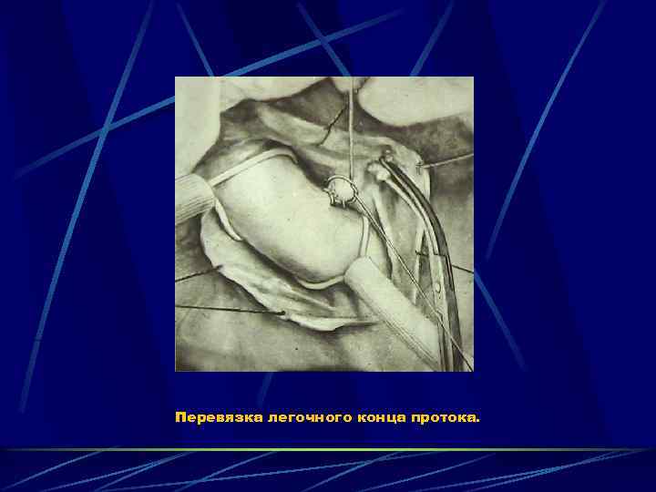 Перевязка легочного конца протока. 
