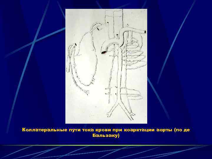 Коллатеральные пути тока крови при коарктации аорты (по де Бальзаку) 