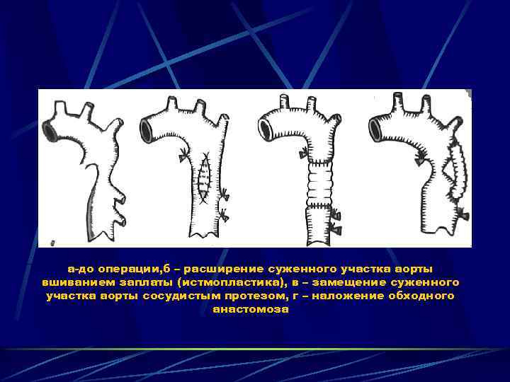 а-до операции, б – расширение суженного участка аорты вшиванием заплаты (истмопластика), в – замещение