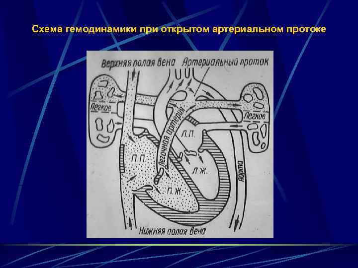 Схема гемодинамики при открытом артериальном протоке 