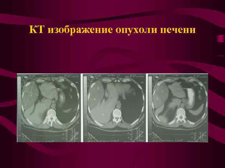 КТ изображение опухоли печени 