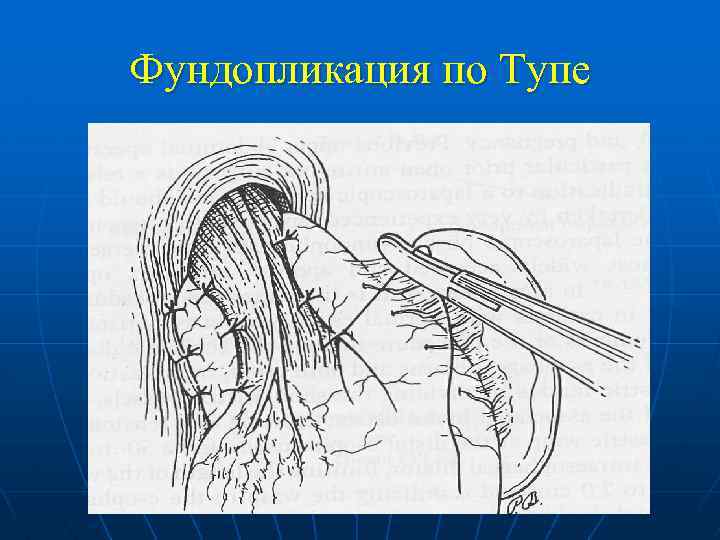 Фундопликация по Тупе 