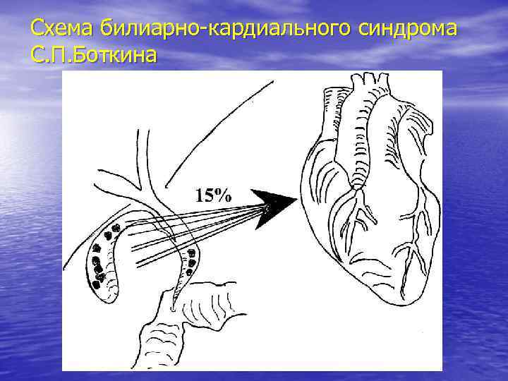 Схема билиарно-кардиального синдрома С. П. Боткина 