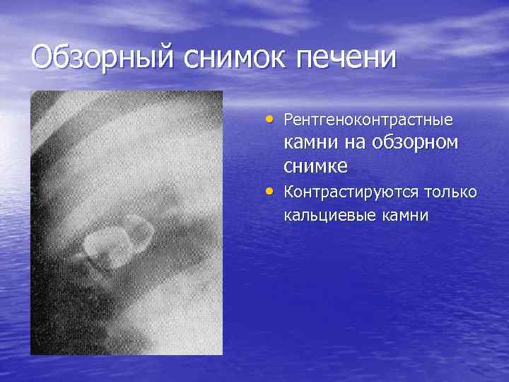 Обзорный снимок печени • Рентгеноконтрастные камни на обзорном снимке • Контрастируются только кальциевые камни