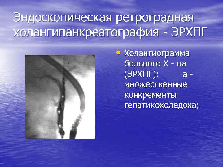 Эндоскопическая ретроградная холангипанкреатография - ЭРХПГ • Холангиограмма больного Х - на (ЭРХПГ): а -